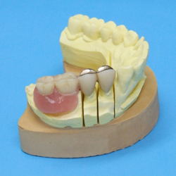 田中ファミリー歯科、コーヌス義歯